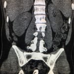 Procedural Sedation for the removal of a rectal foreign body 2 Creative Commons images