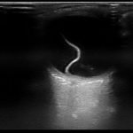 Retinal Detachment 1 Creative Commons images