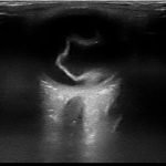 Retinal Detachment 2 Creative Commons images