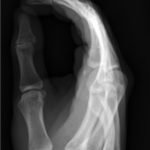 Dorsally-Displaced Metacarpal Dislocation-Fracture 2 Creative Commons images