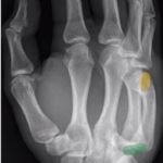 Dorsally-Displaced Metacarpal Dislocation-Fracture 3 Creative Commons images