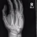 Dorsally-Displaced Metacarpal Dislocation-Fracture 5 Creative Commons images