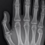Dorsally-Displaced Metacarpal Dislocation-Fracture 7 Creative Commons images