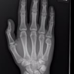 Dorsally-Displaced Metacarpal Dislocation-Fracture 9 Creative Commons images