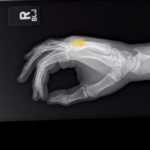 Dorsally-Displaced Metacarpal Dislocation-Fracture 8 Creative Commons images