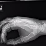 Dorsally-Displaced Metacarpal Dislocation-Fracture 10 Creative Commons images