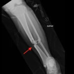 Bilateral Tibia/Fibula Fractures in Automobile versus Pedestrian Accident 2 Creative Commons images