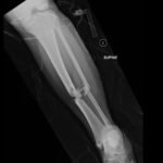 Bilateral Tibia/Fibula Fractures in Automobile versus Pedestrian Accident 3 Creative Commons images