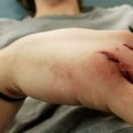 Dorsally-Displaced Metacarpal Dislocation-Fracture 6 Creative Commons images