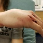 Dorsally-Displaced Metacarpal Dislocation-Fracture 1 Creative Commons images