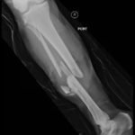 Bilateral Tibia/Fibula Fractures in Automobile versus Pedestrian Accident 4 Creative Commons images