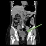 Recurrent Sigmoid Volvulus in a Young Female 1 Creative Commons images