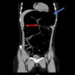 Recurrent Sigmoid Volvulus in a Young Female 2 Creative Commons images