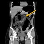 Recurrent Sigmoid Volvulus in a Young Female 3 Creative Commons images
