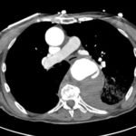 An Unusual Case of Hematemesis 4 Creative Commons images