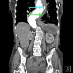 An Unusual Case of Hematemesis 2 Creative Commons images