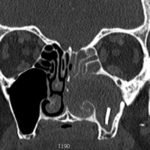Foreign Body in Maxillary Sinus: A Rare Case of Chronic Rhinosinusitis 1 Creative Commons images