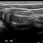 Brief Review of Intussusception Diagnosis and Management 3 Creative Commons images