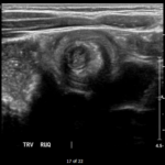 Brief Review of Intussusception Diagnosis and Management 4 Creative Commons images