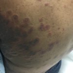 Pemphigoid Gestationis 1 Creative Commons images