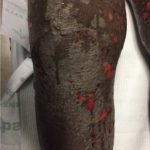 Pemphigoid Gestationis 4 Creative Commons images