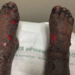 Pemphigoid Gestationis 5 Creative Commons images