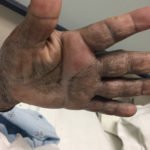 Pemphigoid Gestationis 2 Creative Commons images