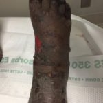 Pemphigoid Gestationis 6 Creative Commons images