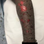 Pemphigoid Gestationis 3 Creative Commons images