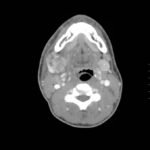 Sialadenitis 2 Creative Commons images