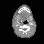 Sialadenitis 3 Creative Commons images