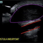 Arteriovenous Graft Pseudoaneurysm 1 Creative Commons images