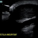 Arteriovenous Graft Pseudoaneurysm 2 Creative Commons images