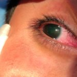 Open Globe with Intraocular Foreign Body 2 Creative Commons images