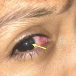 Open Globe with Intraocular Foreign Body 1 Creative Commons images