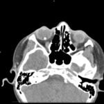 Open Globe with Intraocular Foreign Body 3 Creative Commons images