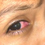 Open Globe with Intraocular Foreign Body 5 Creative Commons images