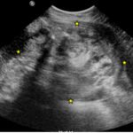 Ovarian Teratoma 2 Creative Commons images