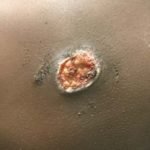 Suspicious Skin Lesion in an 11-Year-Old Male 1 Creative Commons images