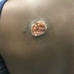 Suspicious Skin Lesion in an 11-Year-Old Male 2 Creative Commons images