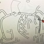 Guilty as Charged: Jailed Coronary Vessel Presenting as Wellens’ Syndrome Type B 3 Creative Commons images