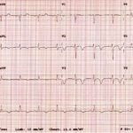Guilty as Charged: Jailed Coronary Vessel Presenting as Wellens’ Syndrome Type B 1 Creative Commons images