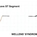Guilty as Charged: Jailed Coronary Vessel Presenting as Wellens’ Syndrome Type B 2 Creative Commons images
