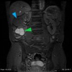 Erectile Dysfunction as a Presenting Symptom for Renal Cell Carcinoma 1 Creative Commons images