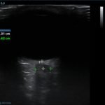 Idiopathic Intracranial Hypertension and Optic Nerve Sheath Diameter 2 Creative Commons images