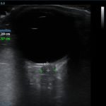 Idiopathic Intracranial Hypertension and Optic Nerve Sheath Diameter 3 Creative Commons images