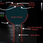 Idiopathic Intracranial Hypertension and Optic Nerve Sheath Diameter 1 Creative Commons images