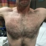 Pectoralis Muscle Tendon Rupture 2 Creative Commons images