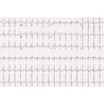 Saddle Pulmonary Embolus 1 Creative Commons images