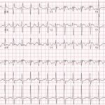 Saddle Pulmonary Embolus 10 Creative Commons images